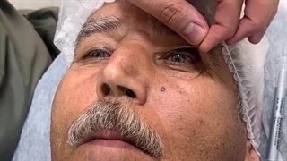 توضیحات عمل بلفاروپلاستی در کلینیک زیبایی آفرینش