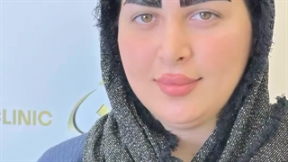ابروهایی جذاب با کاشت تخصصی در کلینیک سینا ( رنسانس )