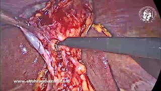 جسم خارجی آزاد داخل شکمی اتفاقی که در طی کوله‌سیستکتومی لاپاروسکوپی کشف شد.