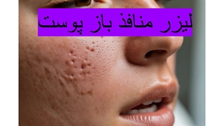 لیزر منافذ باز پوست