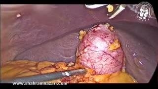 کوله سیستکتومی لاپاراسکوپی در سنگ کیسه صفرا / مجرای سیستیک مسدود شده