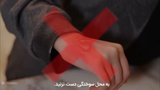 اقدامات اولیه برای سوختگی
