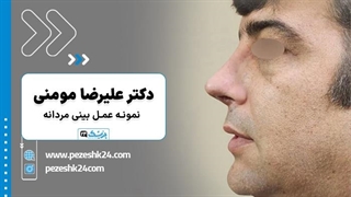 انواع عمل بینی مردانه دکتر علیرضا مومنی در اصفهان - پزشک 24