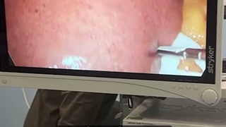 کبد چرب، سه برابر اندازه طبیعی!