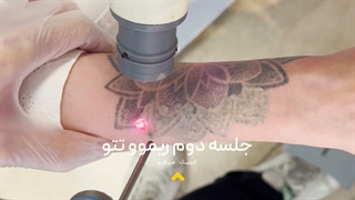 ✨ ریموو تتو با جدیدترین تکنولوژی لیزر