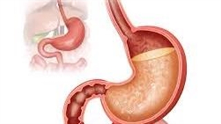 ترش کردن معده، چرا و چگونه؟