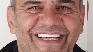 ایمپلنت فول فک بالا