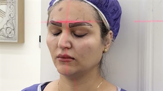 طراحی ابروها به وسیله لیزر در کلینیک سینا