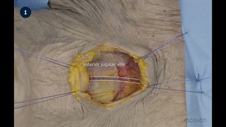 2 Open Thyroidectomy