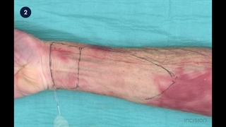 3 Free Radial Forearm Flap