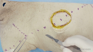 8 Pectoralis Major Flap