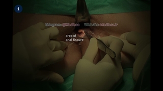 2 Anal Polypectomy