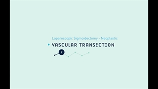 25 Laparoscopic Sigmoidectomy - Neoplastic