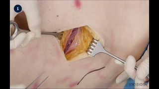 31 Open Appendectomy