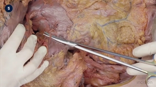 39 Open Gastrectomy - Radical