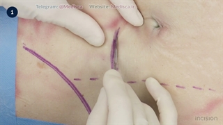 45 Open Loop Transverse Colostomy