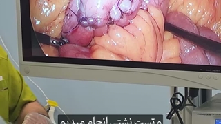 چرا انتخاب نوع جراحی چاقی، کاملاً به رفتار غذایی شما بستگی داره؟
