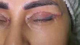 بلافاصله بعد از بفاروپلاستی در کلینیک آرارز