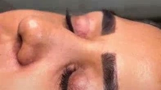 10 روز بعد بلفاروپلاستی