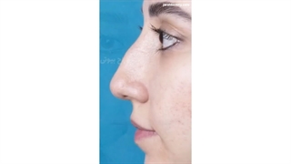 نتیجه طبیعی بینی هماهنگ با چهره