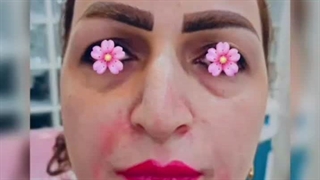 فیلر خط لبخند