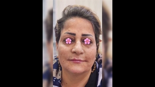 فیلر فول فیس