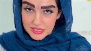 نتیجه کاشت ابرو بعد از 2 سال در کلینیک سینا همان رنسانس معروف