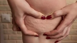 رفع ترک های پوستی با دستگاه پزشکی Carboxy Therapy
